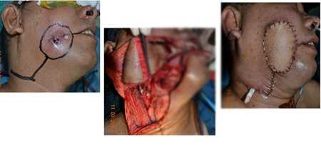 Cancer Of Buccal Mucosa
